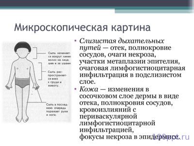 Презентация корь - слайд 5 5 слайд презентации корь