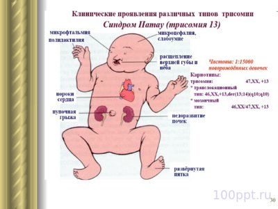 Презентация патология наследственности - слайд 7 7 слайд презентации патология наследственности