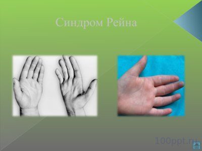 Презентация наследственные болезни - слайд 8 8 слайд презентации наследственные болезни